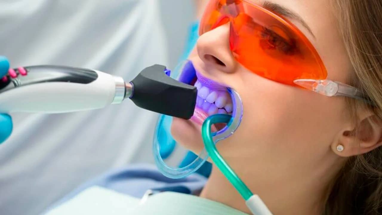 Clareamento dental profissional